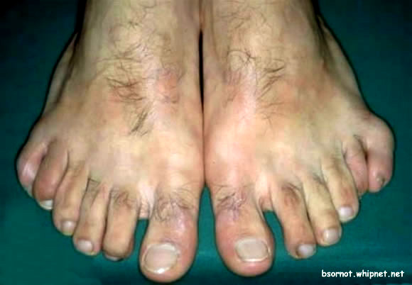 six toes, sextuplet, redneck foot, redneck toes, extra toe