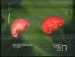 Microcephalic Brain vs Hobbit Brain