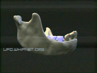 The lower jaw of the Hobbit shows  emerged wisdom teeth and worn molars