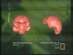 Microcephalic Brain